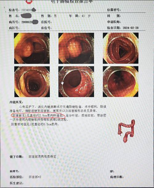 无痛肠镜