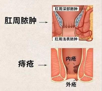 痔疮旁边的硬块是如何形成的？