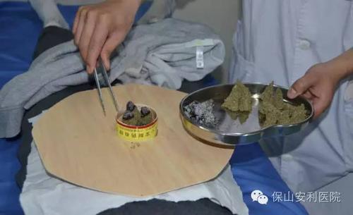 柳枝大蒜疗法