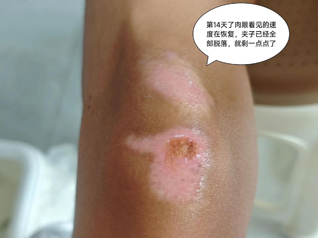 快速愈合
