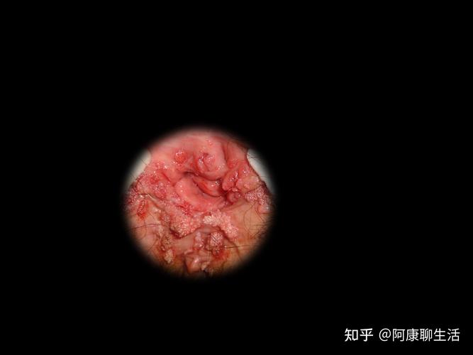 电灼治疗痔疮
