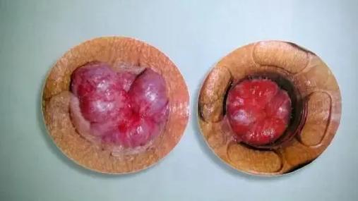 伤寒论，痔疮，症状，治法