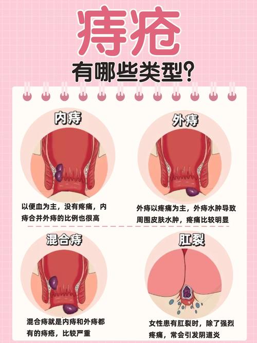 痔疮瘪了