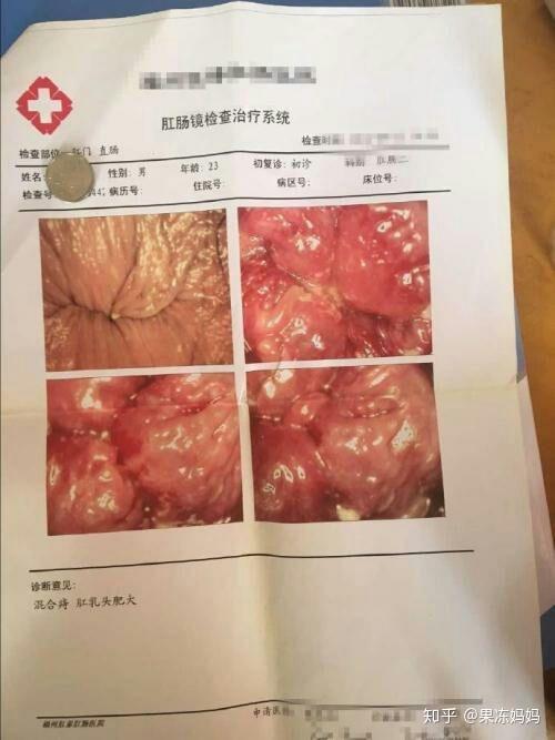 静脉曲张性痔疮