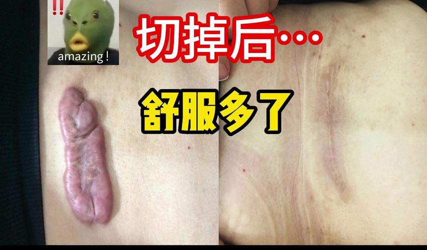 痔疮球肉条