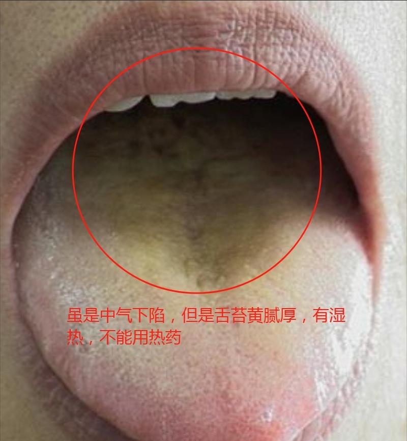 中气下陷