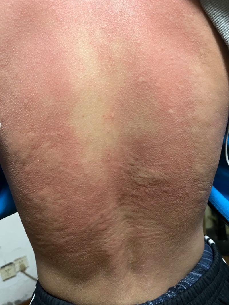 后遗症