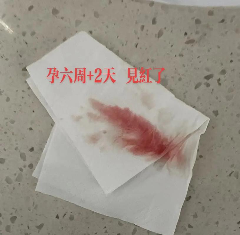 早孕痔疮出血