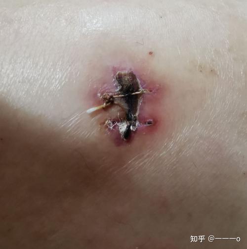 男性痔疮疤痕