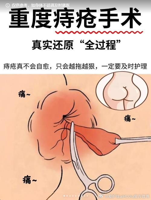 痔疮手术后天天都痛吗？