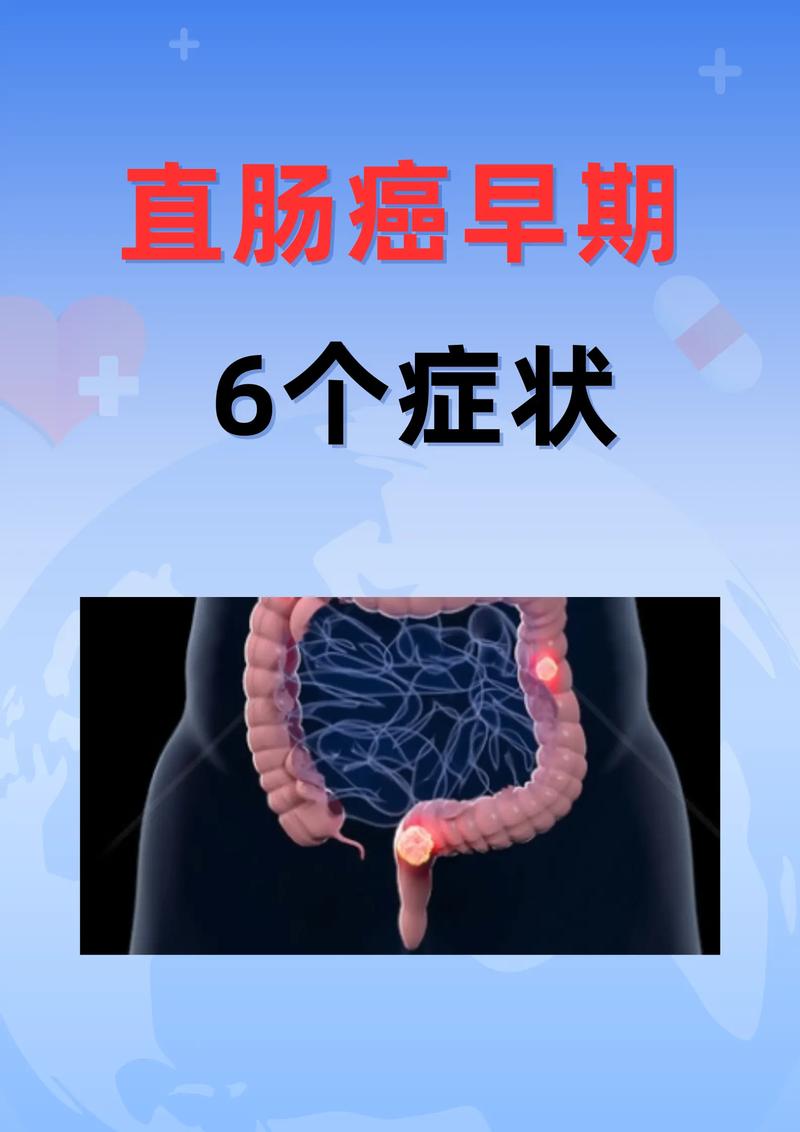 直肠癌
