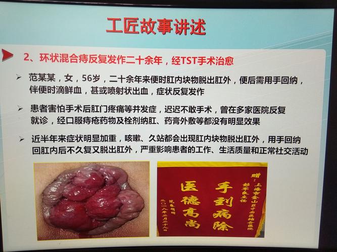 痔疮手术副作用