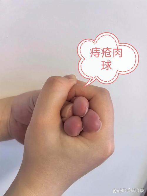 痔疮小肉球
