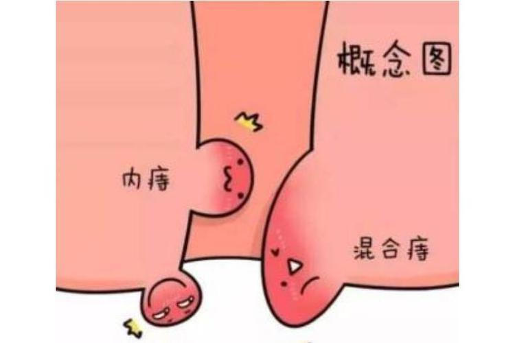 痔疮无血肿痛