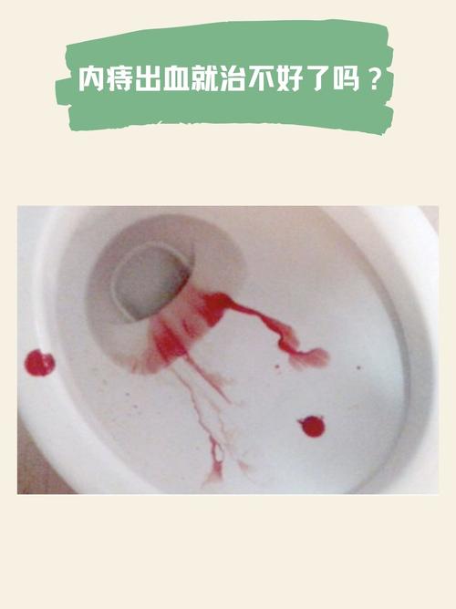 痔疮失血