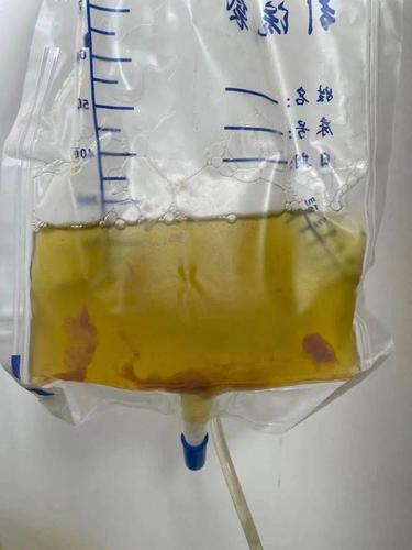渗出液