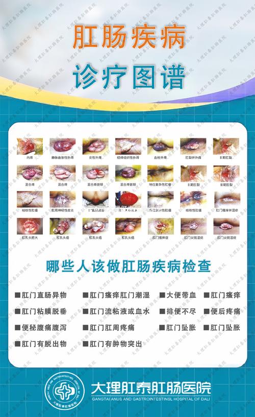 绵阳治痔疮