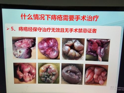 痔疮二期