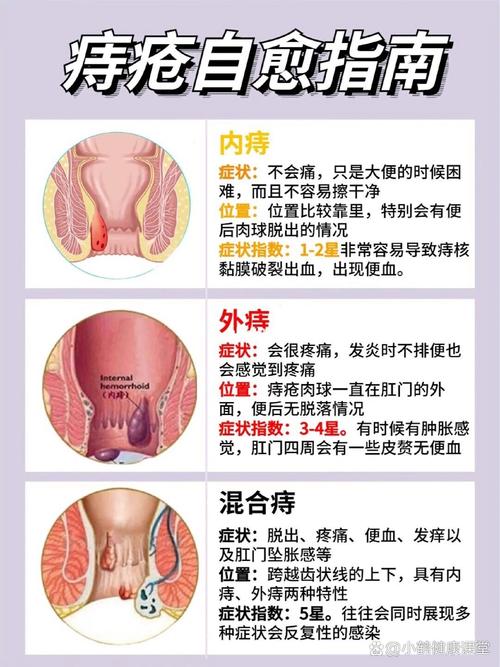 痔疮治疗地点