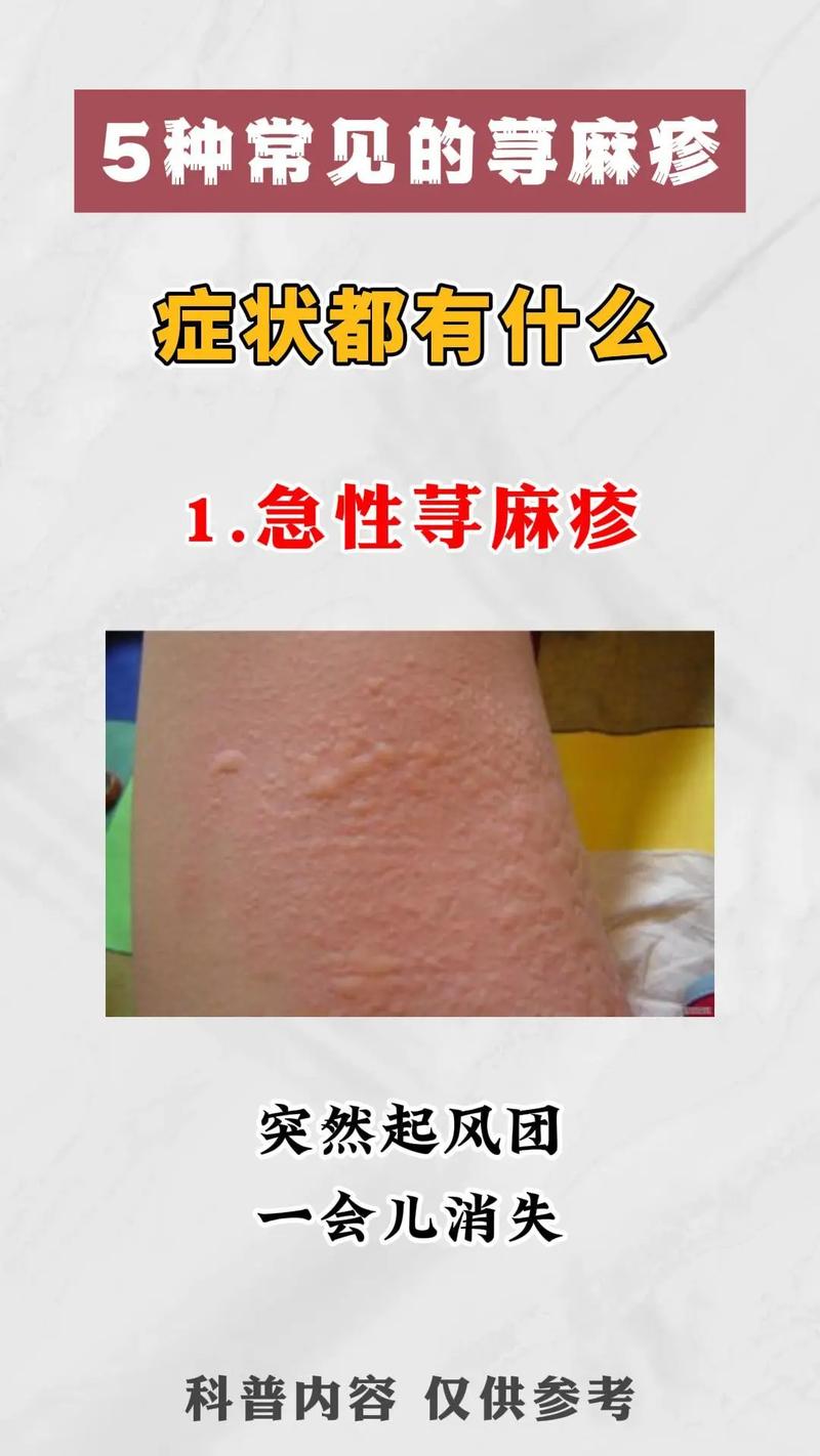  寻麻疹