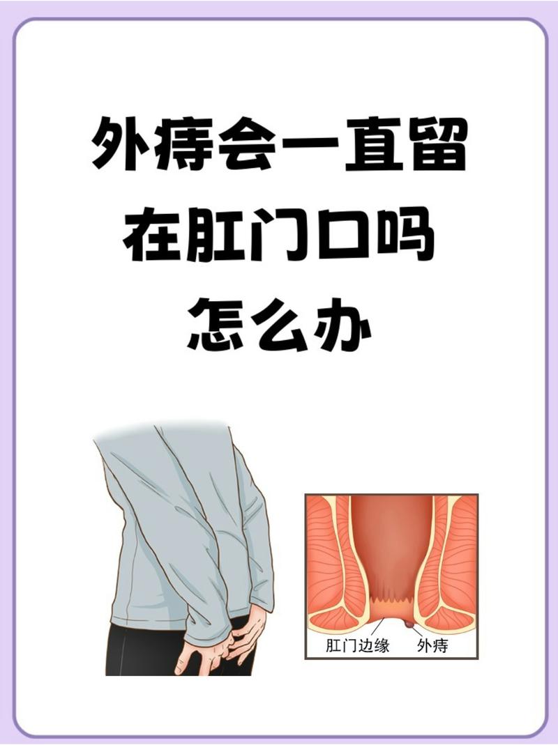 外痔疼痛瘙痒