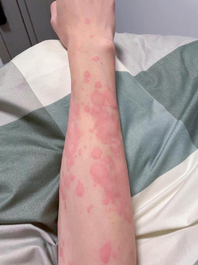 急性荨麻疹