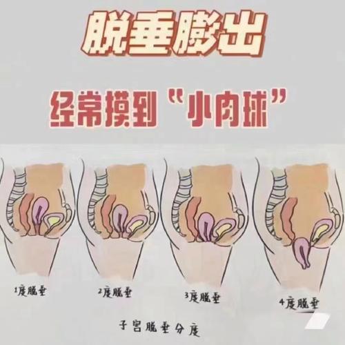  脱垂