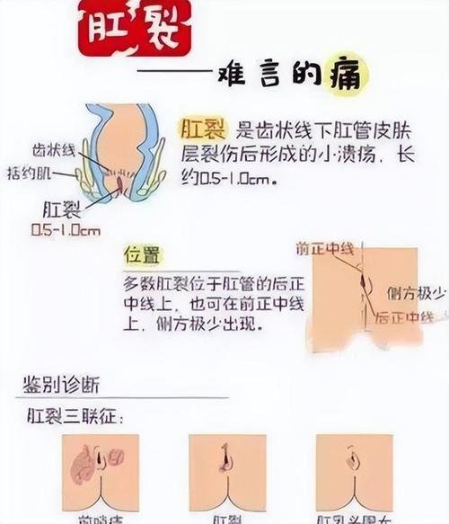 三周排便疼痛