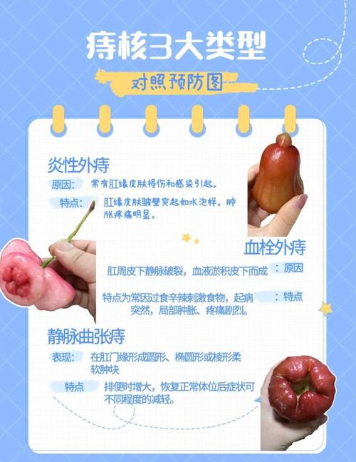 痔疮肉球肿胀