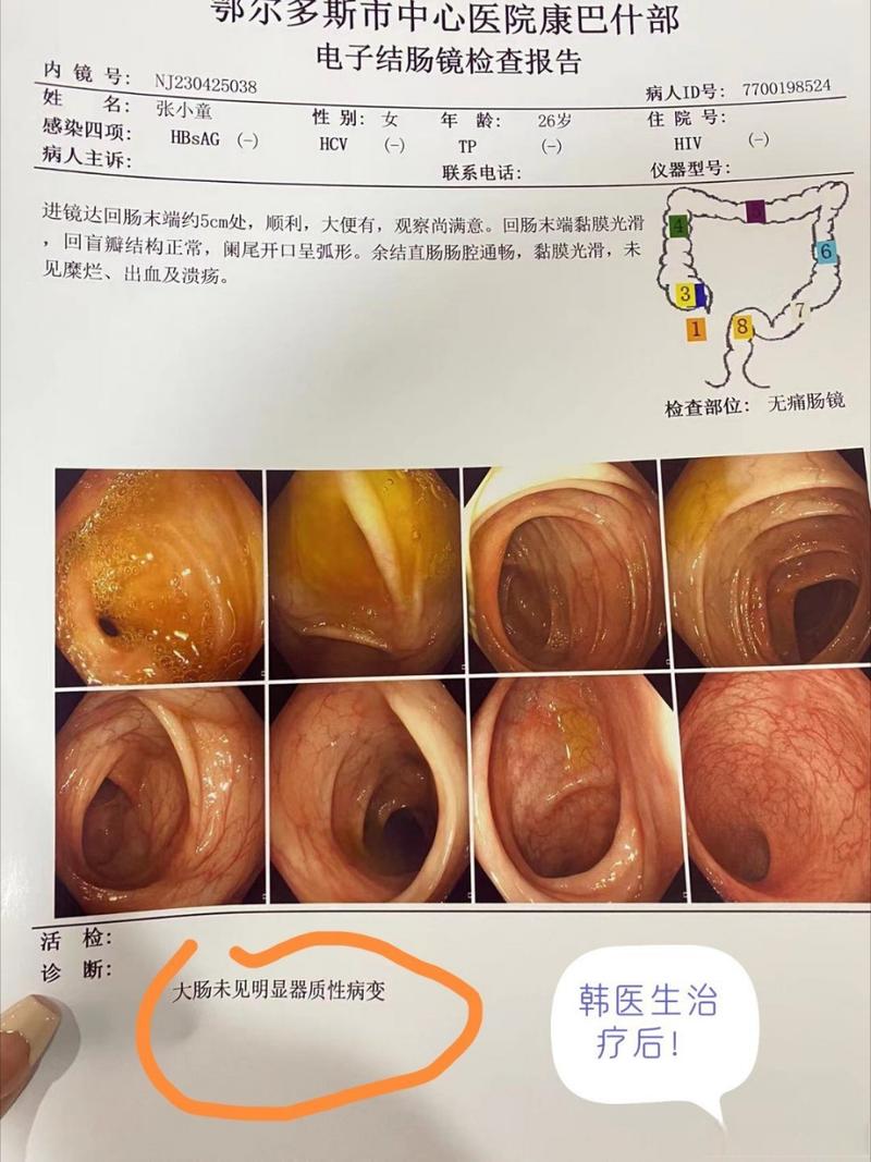 痔疮溃疡
