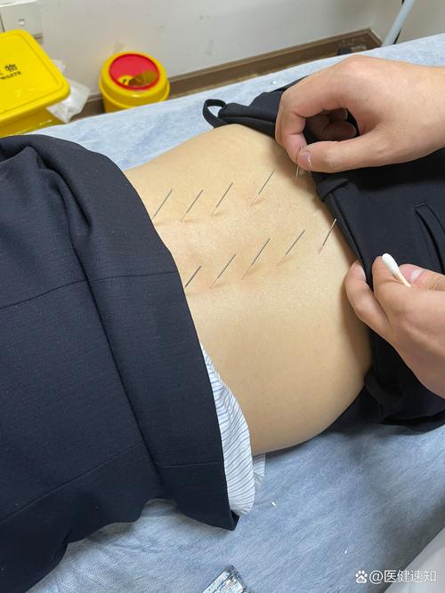 背部针灸