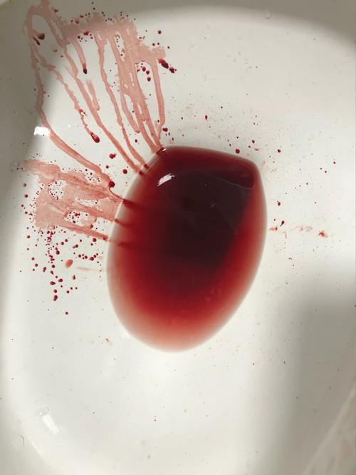 喷血痔疮