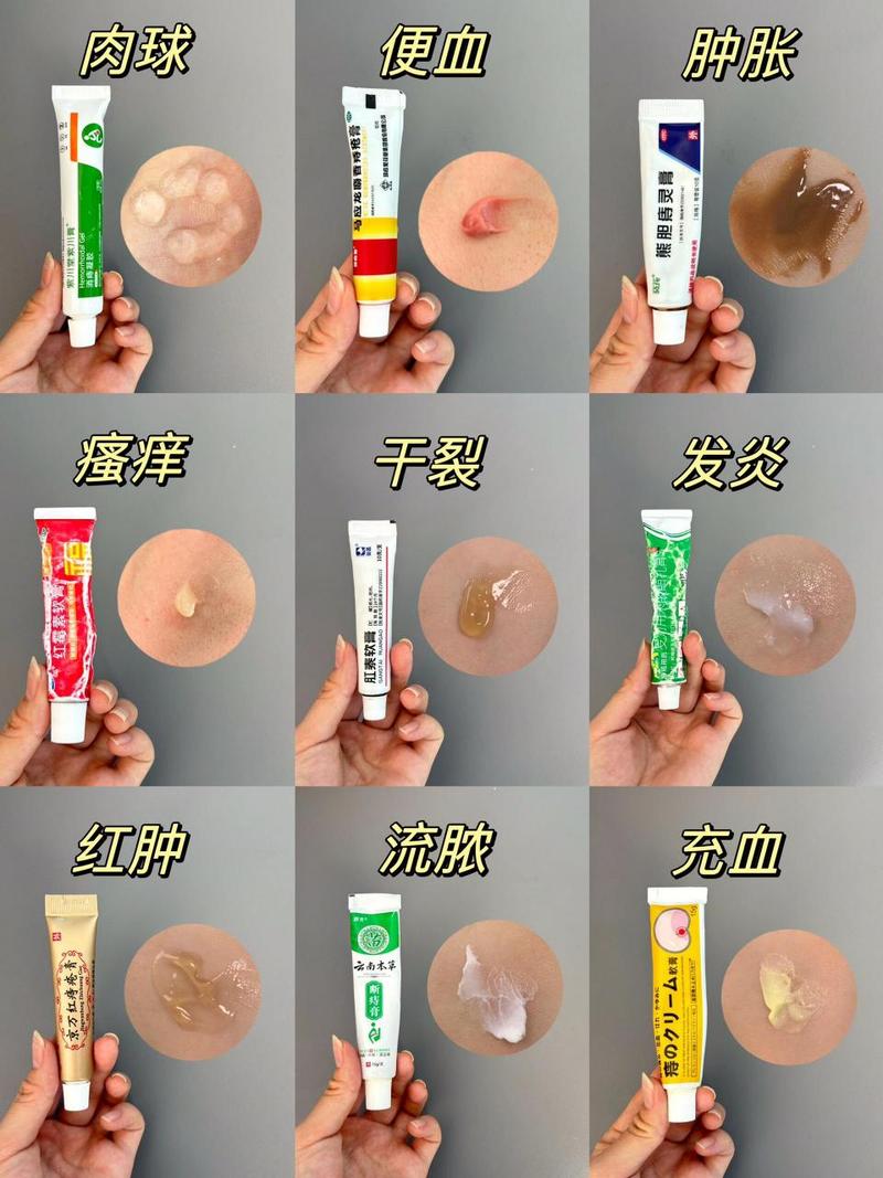 痔疮肿胀