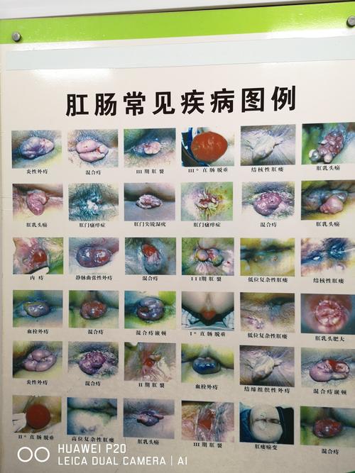 外痔长疣