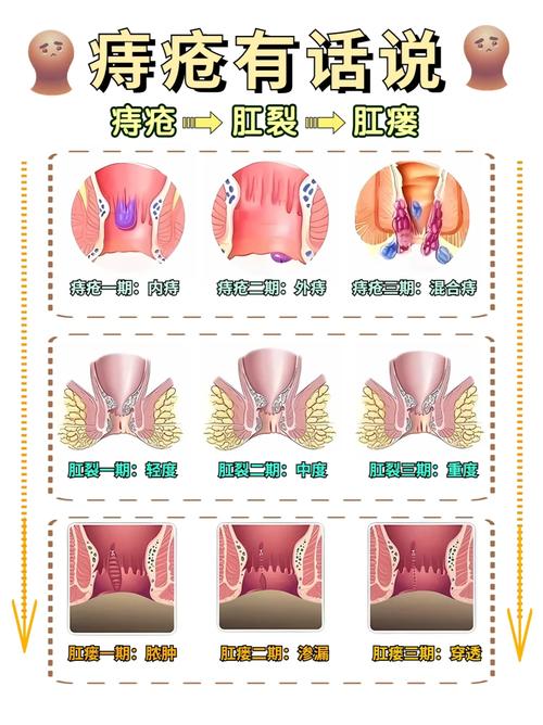 一二期痔疮