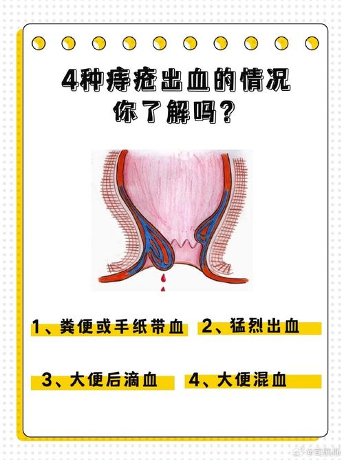 痔疮出血原因