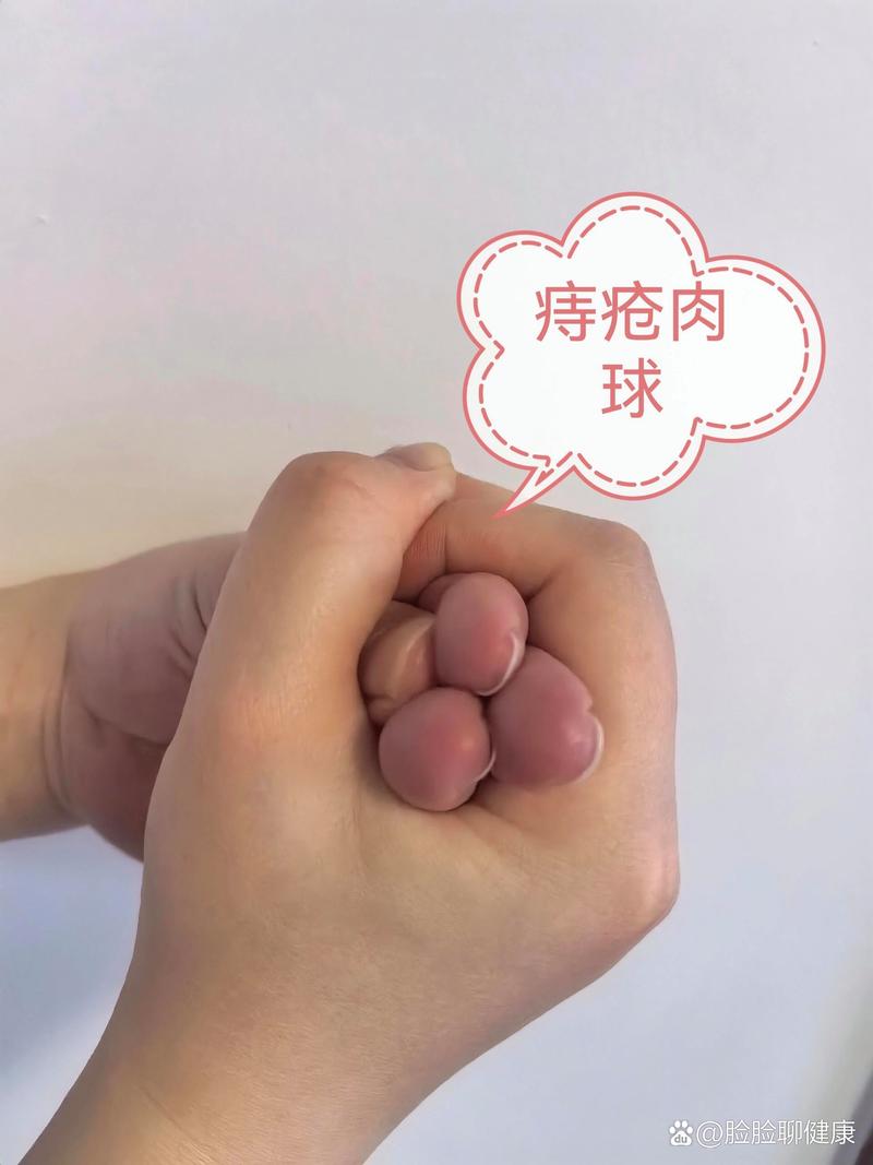中度痔疮