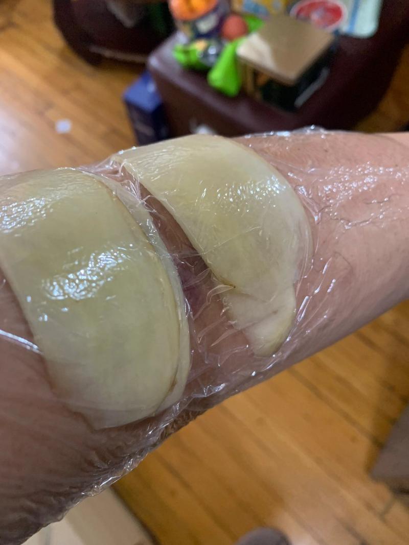 土豆片贴敷