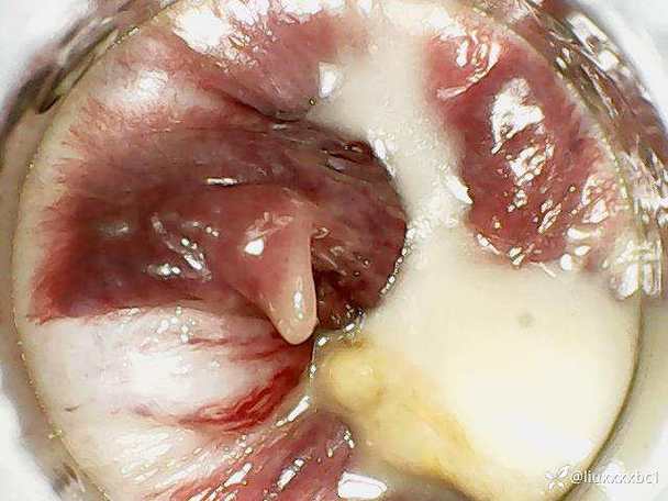 肛肉流脓