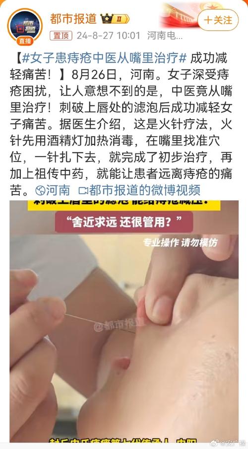 中医内痔治疗