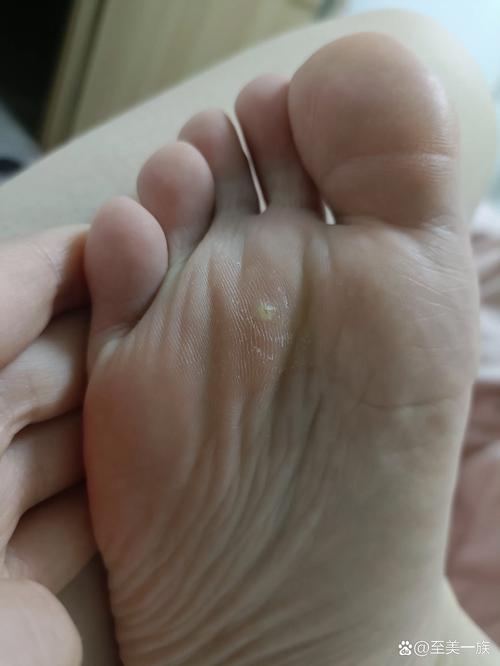鸡眼