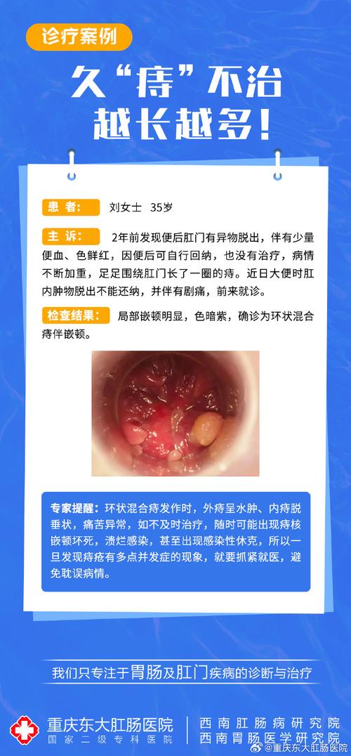 痔疮突发
