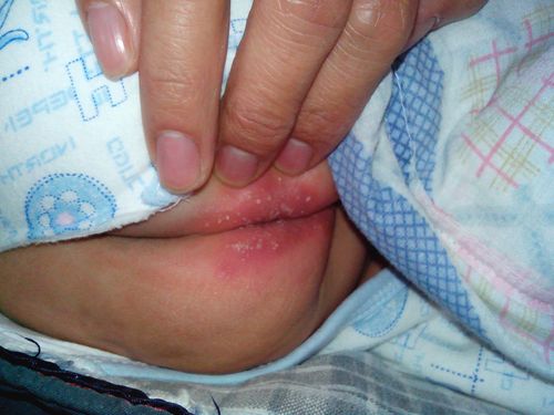肛周流脓水