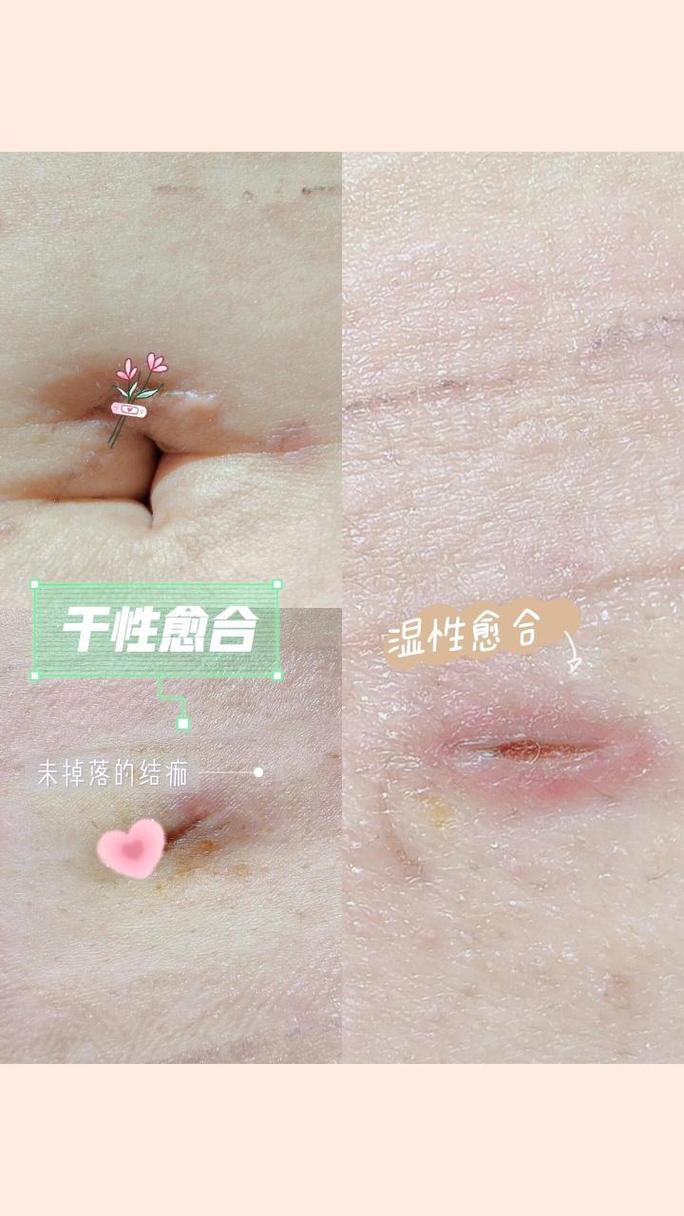 术后愈合