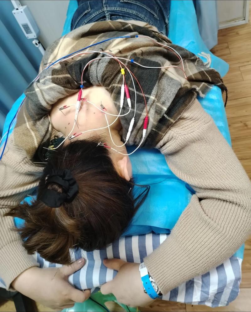 电针治疗