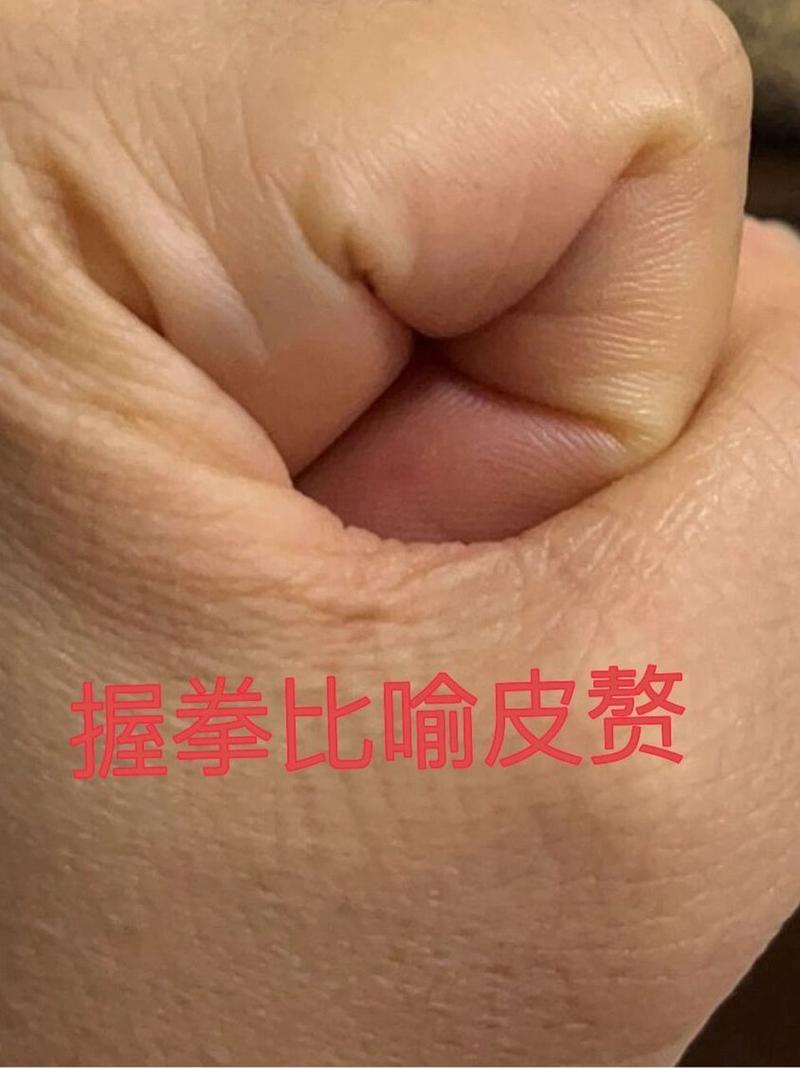 痔疮皮赘