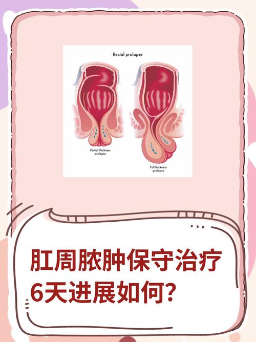 肛门治疗