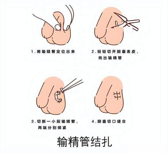 结扎法
