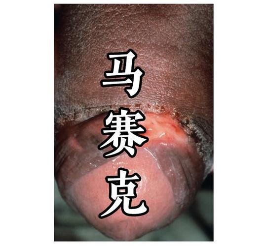 梅毒