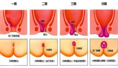 正常肛门